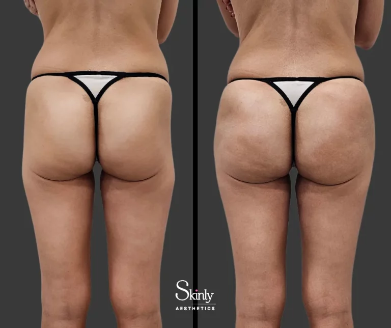 Before and after Sculptra hip dip correction for smoother curves.