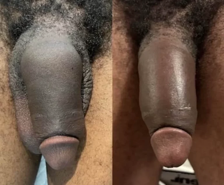 Before and after shaft filler showing enhanced penile width.