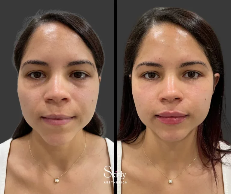 Before and after smile line filler, showing a refreshed appearance.