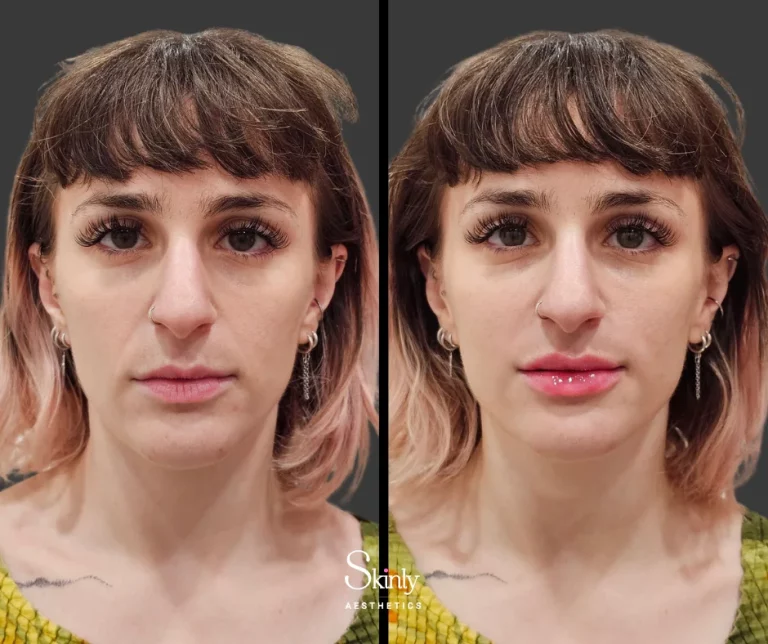 Before and after smile line filler showing softened facial creases.