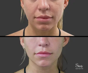 Before and after smile line filler, showing more youthful appearance.