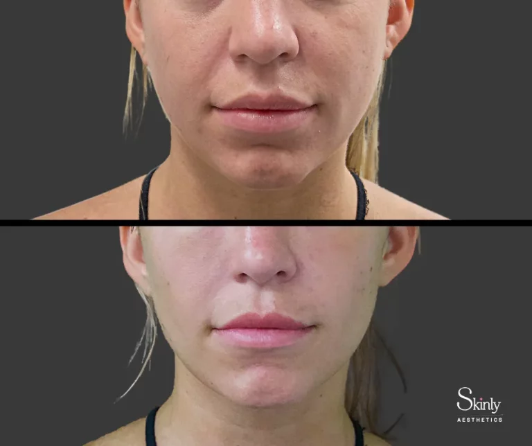 Before and after smile line filler, showing more youthful appearance.