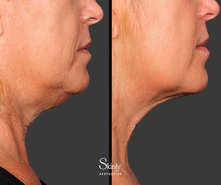 Before and after Kybella injections, showing submental fat reduction.