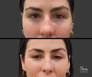 Before and after tear trough correction with dermal filler.