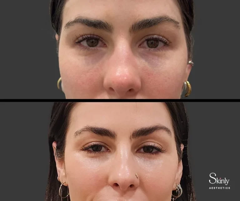 Before and after tear trough correction with dermal filler.