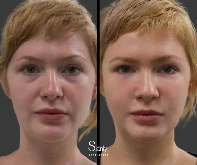 Before and after tear trough filler showing corrected under eye hollows.
