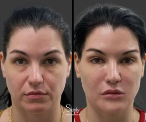 Before and after tear trough filler, showing brighter under eyes.