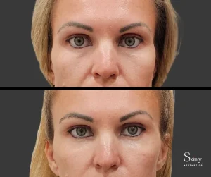 Before and after under eye filler showing brightened tear troughs.