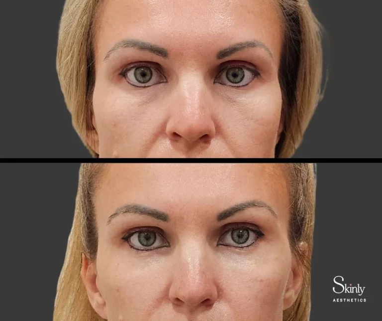 Before and after under eye filler showing brightened tear troughs.