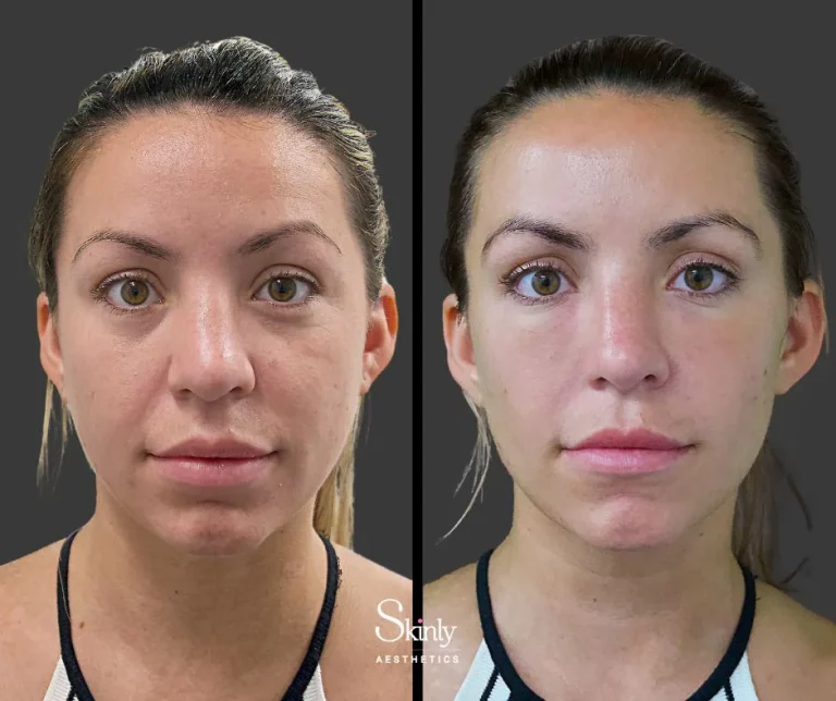 Before and after under eye filler showing restored volume under eyes.
