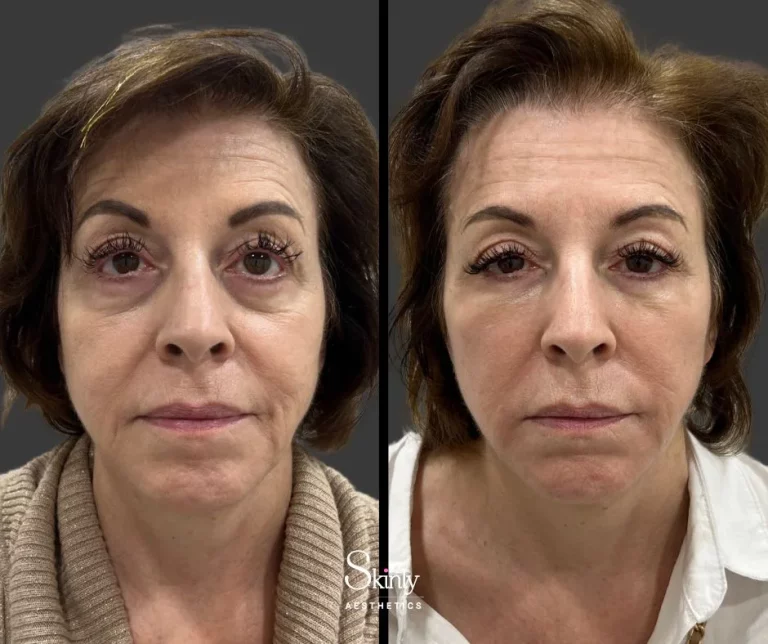 Before and after under eye filler for dark circle reduction.