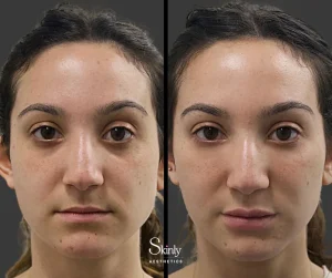 Before and after under eye rejuvenation with filler.