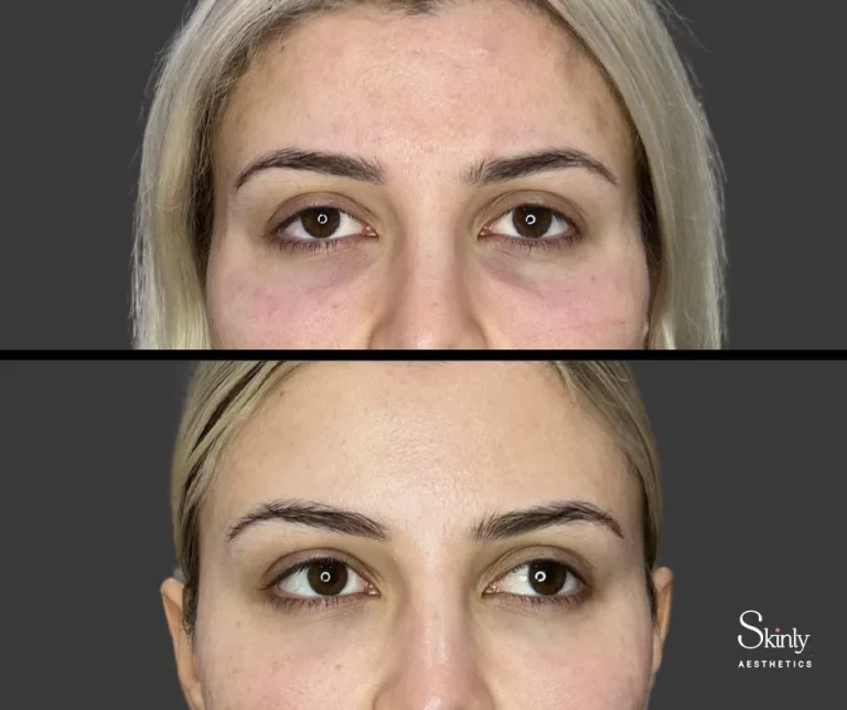 Before and after under eye injections for volume restoration.