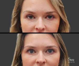 Before and after Upneeq eye drops, showing improved eyelid position.