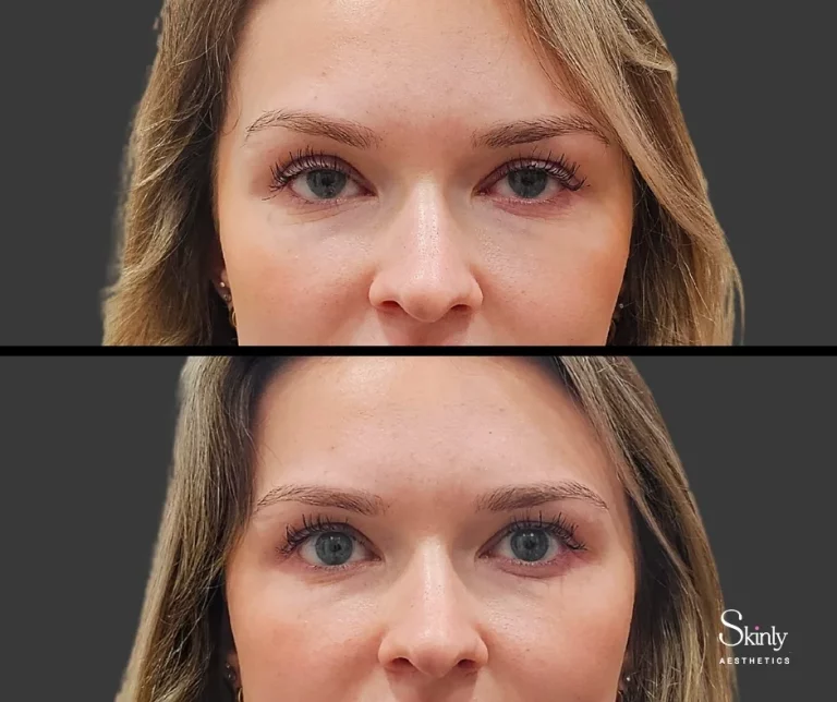 Before and after Upneeq eye drops, showing improved eyelid position.