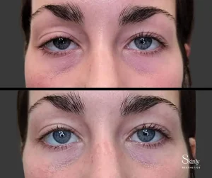 Upneeq for lazy eyes before and after, showing balanced eye symmetry.