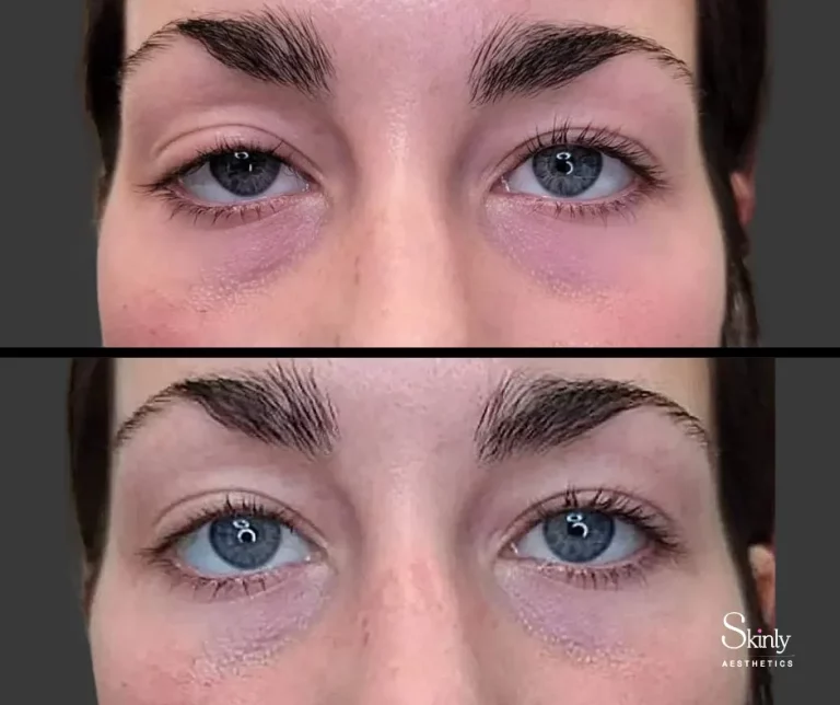 Upneeq for lazy eyes before and after, showing balanced eye symmetry.