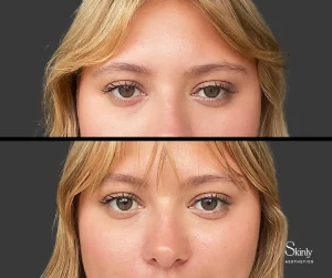 Before and after Upneeq results, showing upper lid lift.