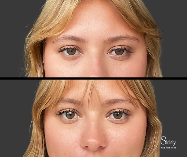 Before and after Upneeq results, showing upper lid lift.