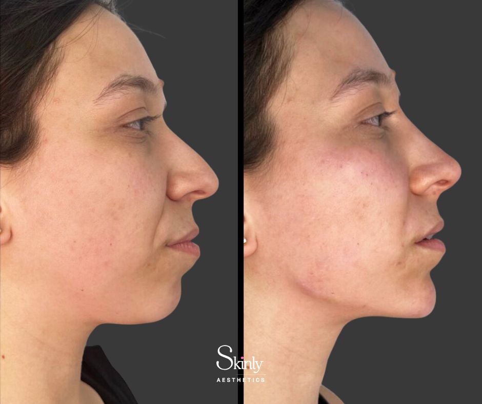 Endolift jawline results showing improved definition and reduction of jowls