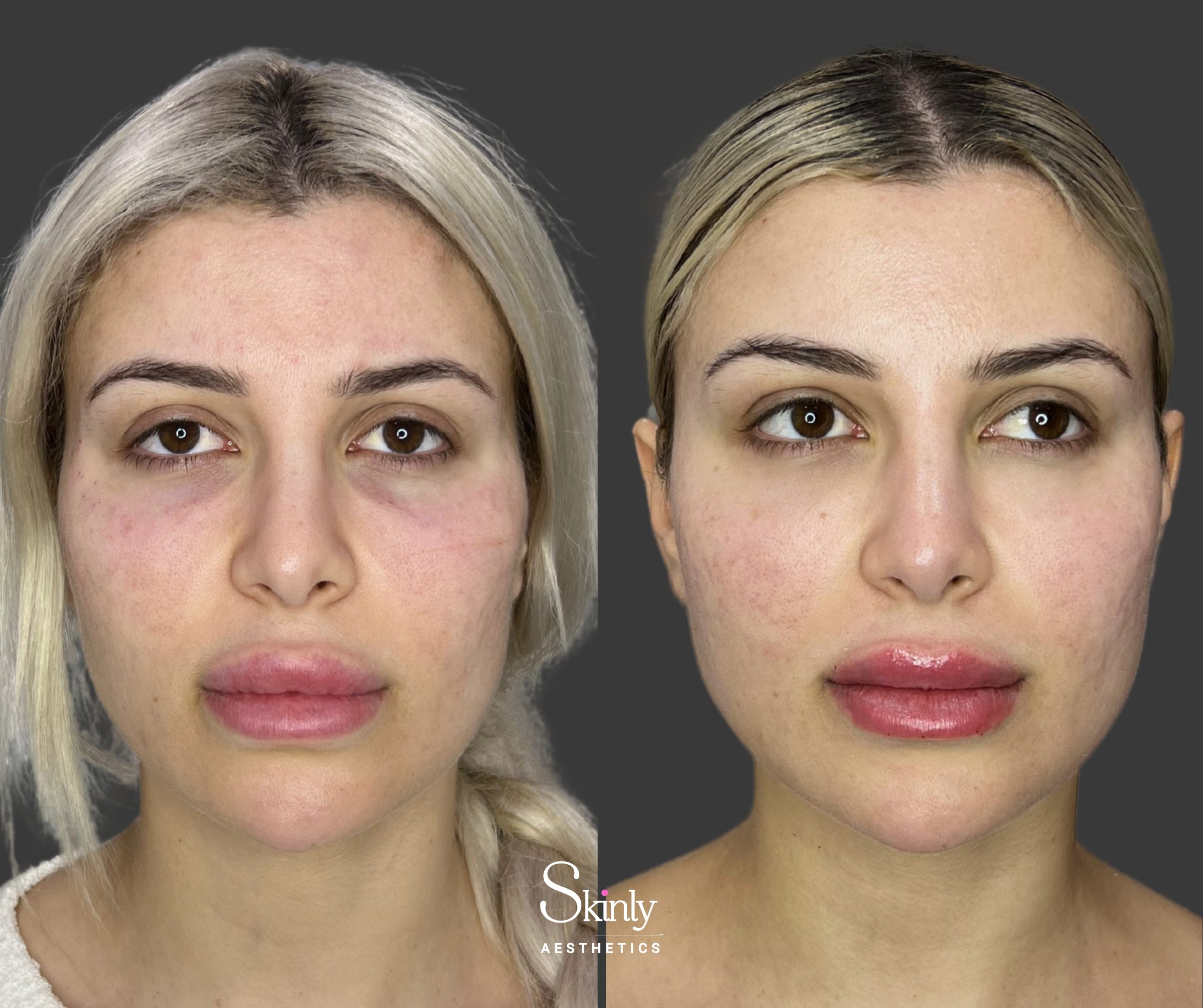 Natural under eye filler before and after results