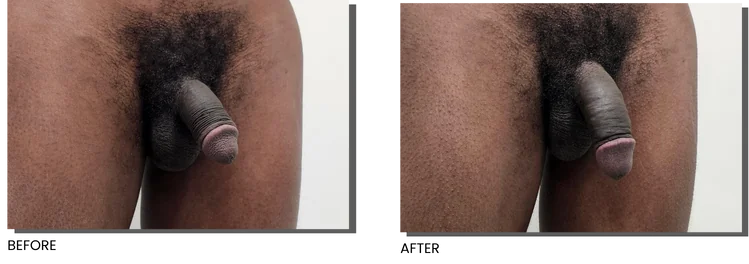 Before and after penile filler showing visible girth increase, Skinly Aesthetics NYC