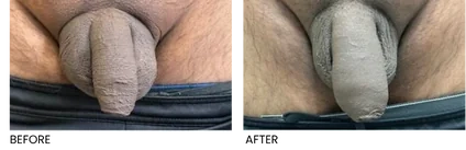 Before and after penis enlargement injections with fuller, thicker overall contour