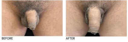 Penis filler before and after in NYC showing smooth, even, natural-looking result