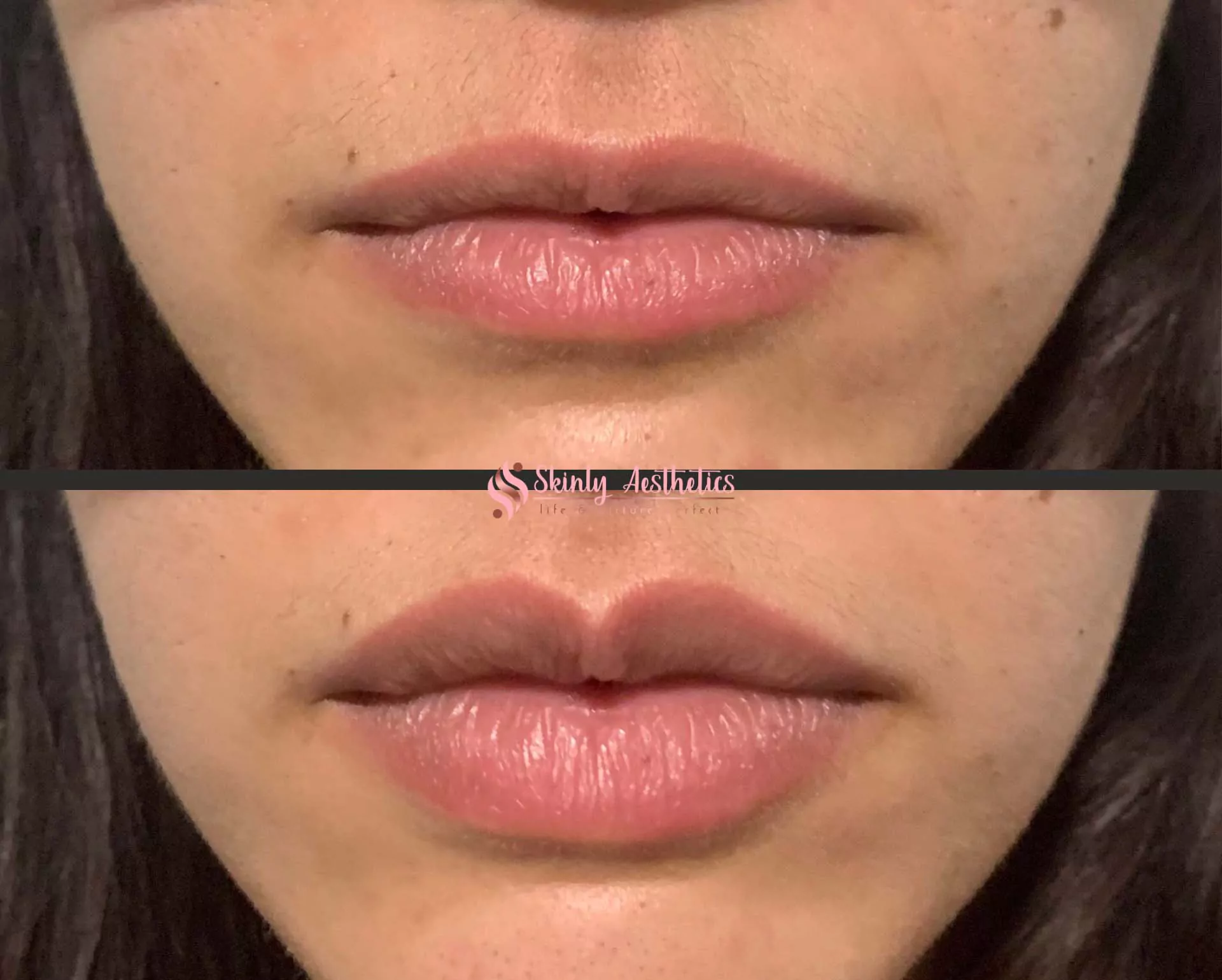 Lip augmentation before and after with fuller natural-looking lips