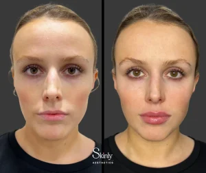 Lip filler before and after showing balanced volume and shape