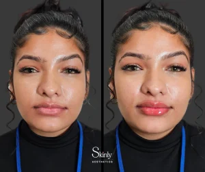 Lip filler before and after showing increased volume and improved contour