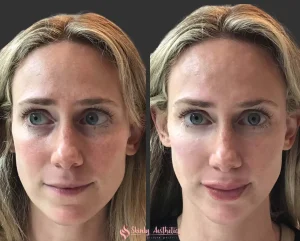 Lip filler before and after showing increased volume and improved contour