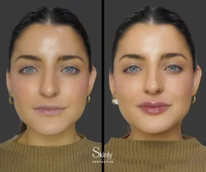 Lip filler before and after showing improved volume and definition