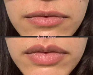 Lip filler before and after showing improved volume and definition