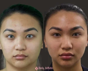 Lip filler before and after showing fuller upper and lower lips