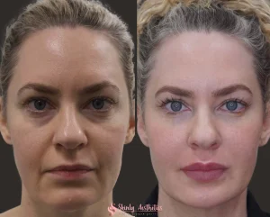 Lip filler before and after showing fuller upper and lower lips