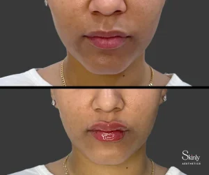 Lip filler before and after showing subtle natural-looking enhancement