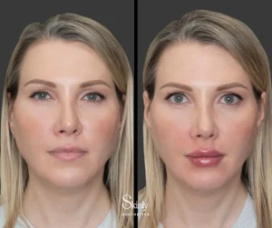 Lip filler before and after showing soft natural-looking volume