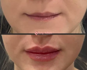 Lip filler before and after showing subtle volume and definition