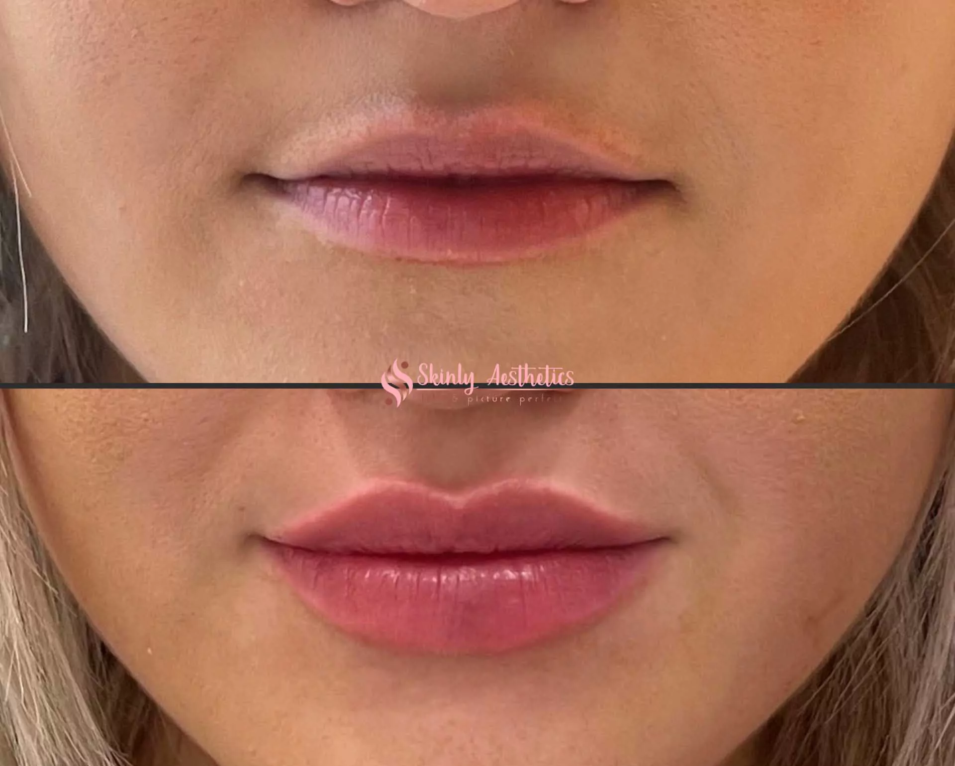 Lip filler before and after showing fuller, more defined lips