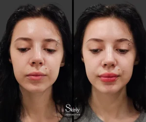 Lip filler before and after showing improved upper and lower lip proportions