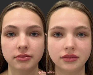 Lip filler before and after showing increased volume and definition