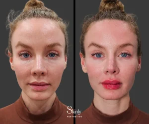 Lip filler before and after showing fuller volume and improved shape