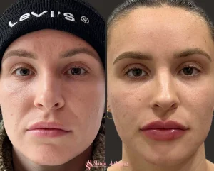 Lip filler before and after showing enhanced volume and shape