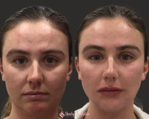 Lip filler before and after showing improved shape and fullness
