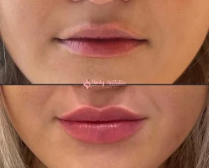 Lip filler before and after showing subtle natural volume enhancement