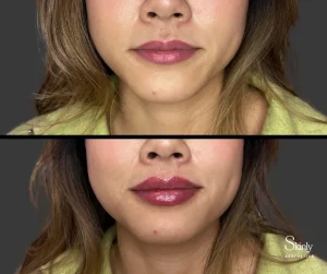 Lip filler before and after showing improved lip symmetry