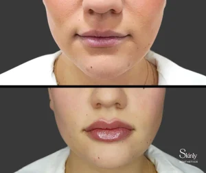 Lip filler before and after showing increased lip volume