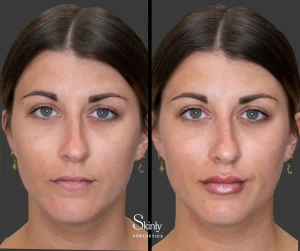 Lip filler before and after showing restored lip volume