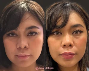 Lip filler before and after showing increased volume and definition